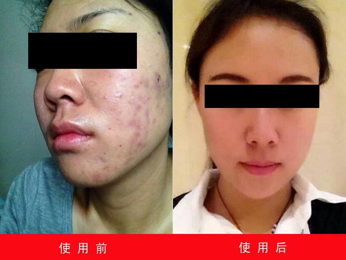 中州藥膏使用前后對比