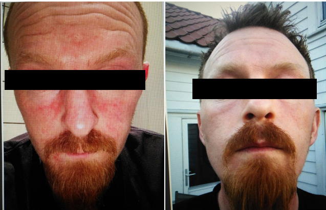 中州藥膏使用前后對比